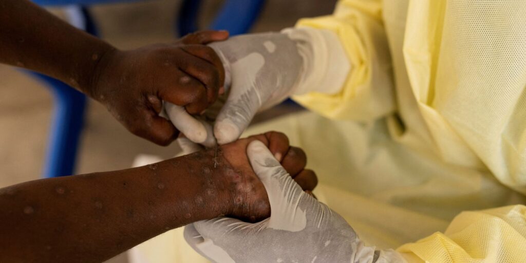 África declara emergência em saúde pública por epidemia de mpox