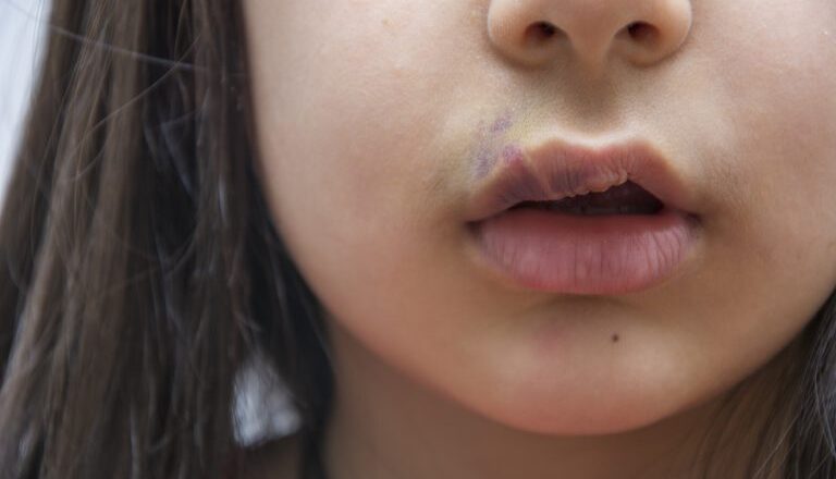 Comissão debate políticas públicas de atenção integral às pessoas com fissura labiopalatina – Notícias
