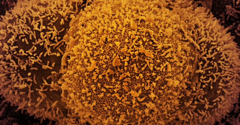 Covid-19: un caso más de la nueva variante Eris en Brasil