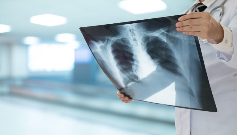 Comissão debate a formulação de políticas públicas para pessoas com hipertensão pulmonar crônica - Notícias