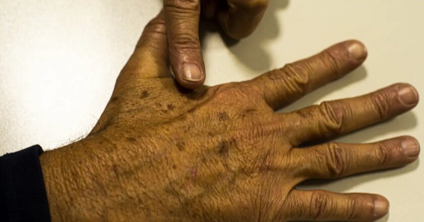 Tecnologia para tratar câncer de pele é aprovada para uso no SUS