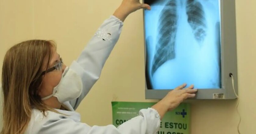 Brasil crea comité interministerial para eliminar la tuberculosis
