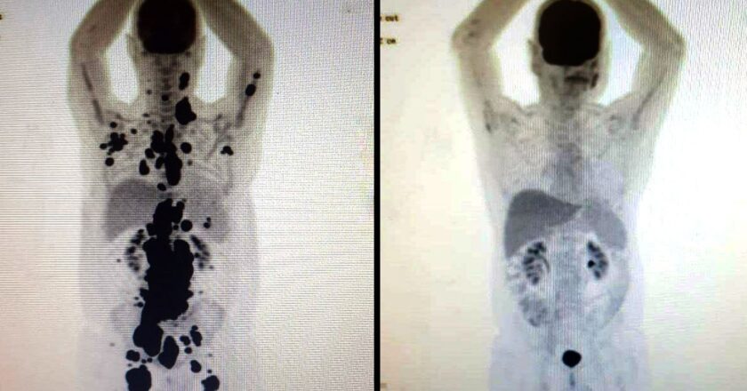 Tratamento promissor contra câncer é estudado pelo SUS