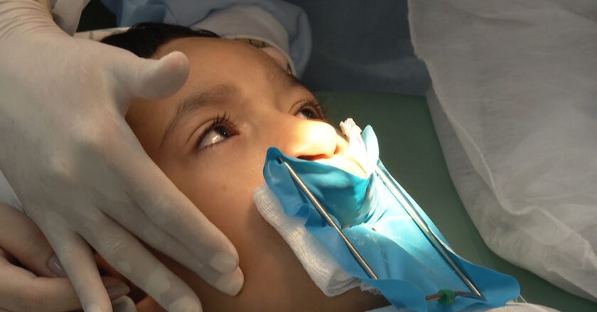 Genética e inflamação na gravidez explicam fissura labiopalatina