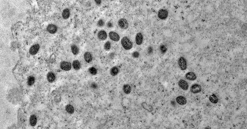 Pesquisa indica risco de monkeypox agravar infeccão por HIV