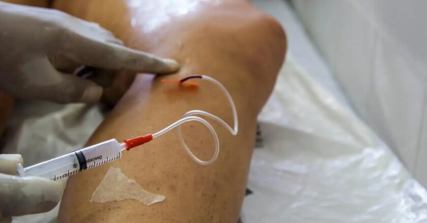 A cada dia, 145 mulheres são internadas para tratar varizes